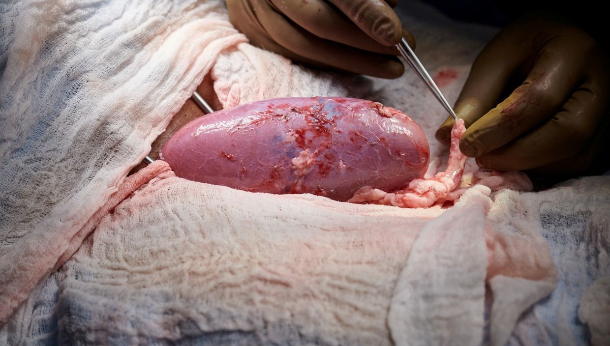 Dünyada ilk kez hayvan organı bir insana başarıyla nakledildi: Yüz binlerce hayatı kurtarabilir